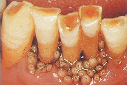 3. Hệ lụy sức khỏe từ nhiễm giòi